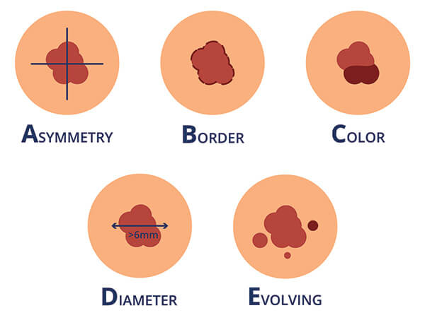 Chart Illustrating what asymmetry, border, color, diameter and evolving skin cancers look like