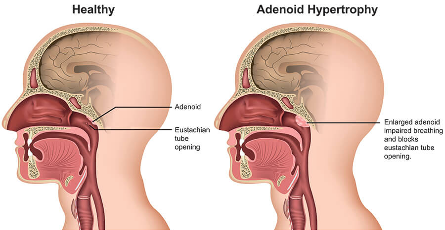 Chart Illustrating a Healthy Adenoid Compared to One WIth Hypertrophy