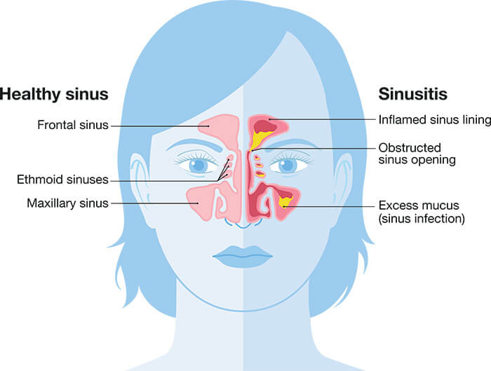 Chart Illustrating a Healthy Sinus vs One Experiencing Sinusitis