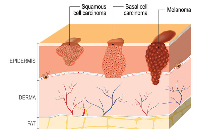 Chart Illustrating Basal Cell Carcinoma, Squamous Cell Carcinoma and Melanoma