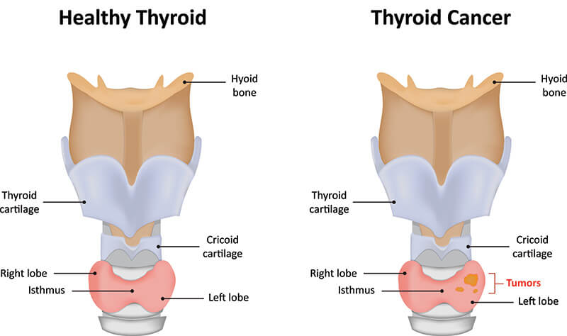 Chart Illustrating a Healthy Thyroid compared to one with Thyroid Cancer